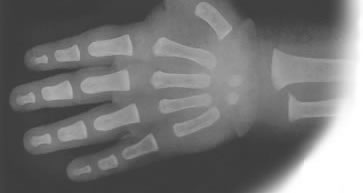 (c) 1950 Greulich & Pyle / X-ray of 6 mo. boy's hand